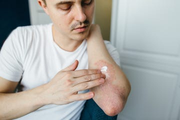 man who uses ointments, creams in the treatment of eczema, psoriasis and other skin diseases