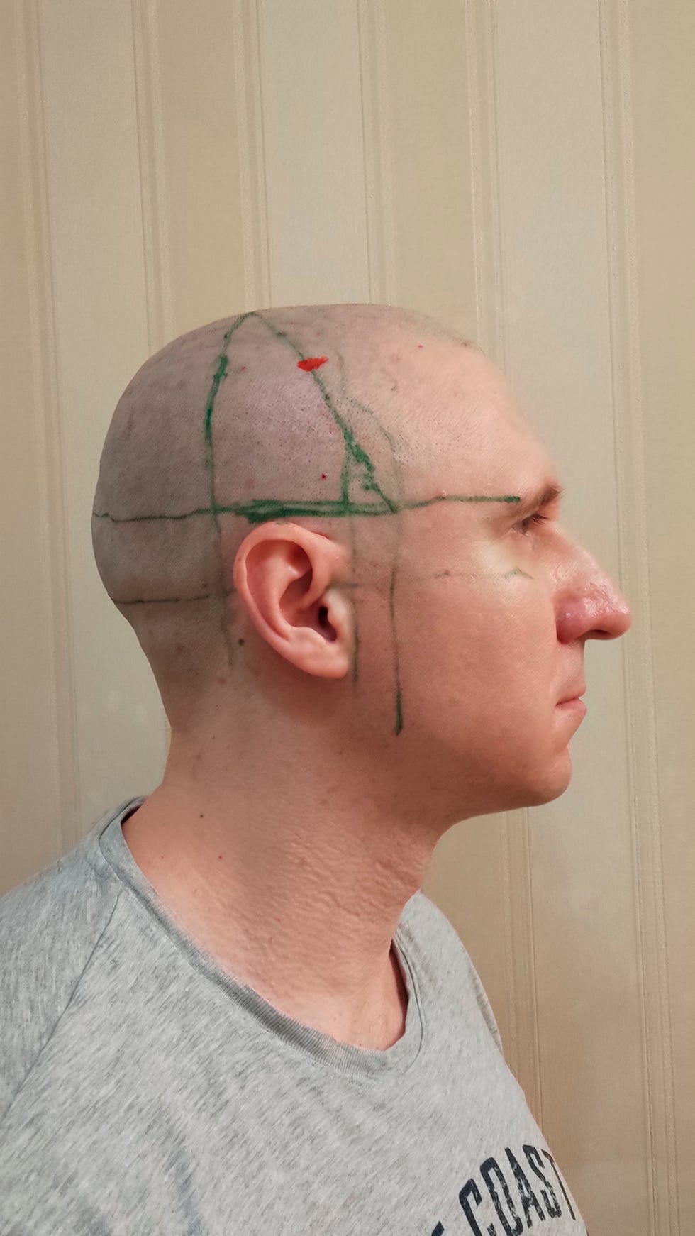 marked up head to show lines for brain surgery marked up head to show lines for brain surgery