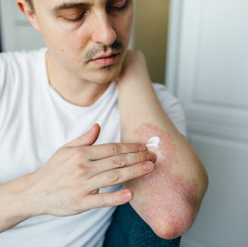 Man who uses ointments, creams in the treatment of eczema, psoriasis and other skin diseases such as fungus, plaque, rash and spots. Autoimmune genetic disease. man who uses ointments, creams in the treatment of eczema, psoriasis and other skin diseases